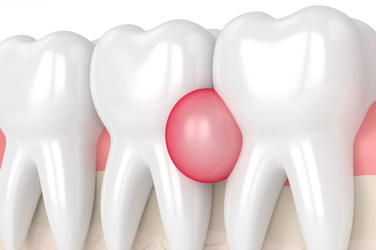 برای عفونت دندان چه بخوریم؟ 1 43289432
