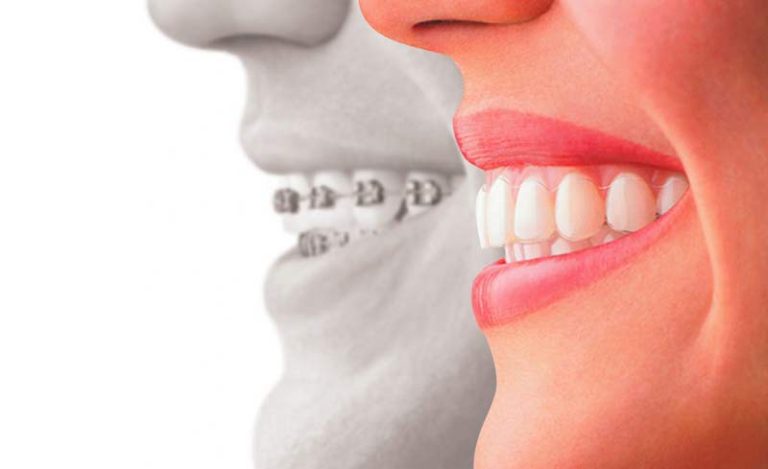 ارتودنسی نامرئی 1 ارتودنسی نامرئی 45 768x469 1