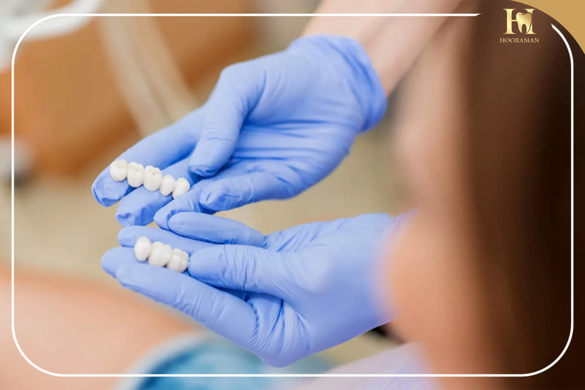 روکش تمام دندان ها در کلینیک دندانپزشکی هورامان 3 طول عمر روکش تمام دندان ها