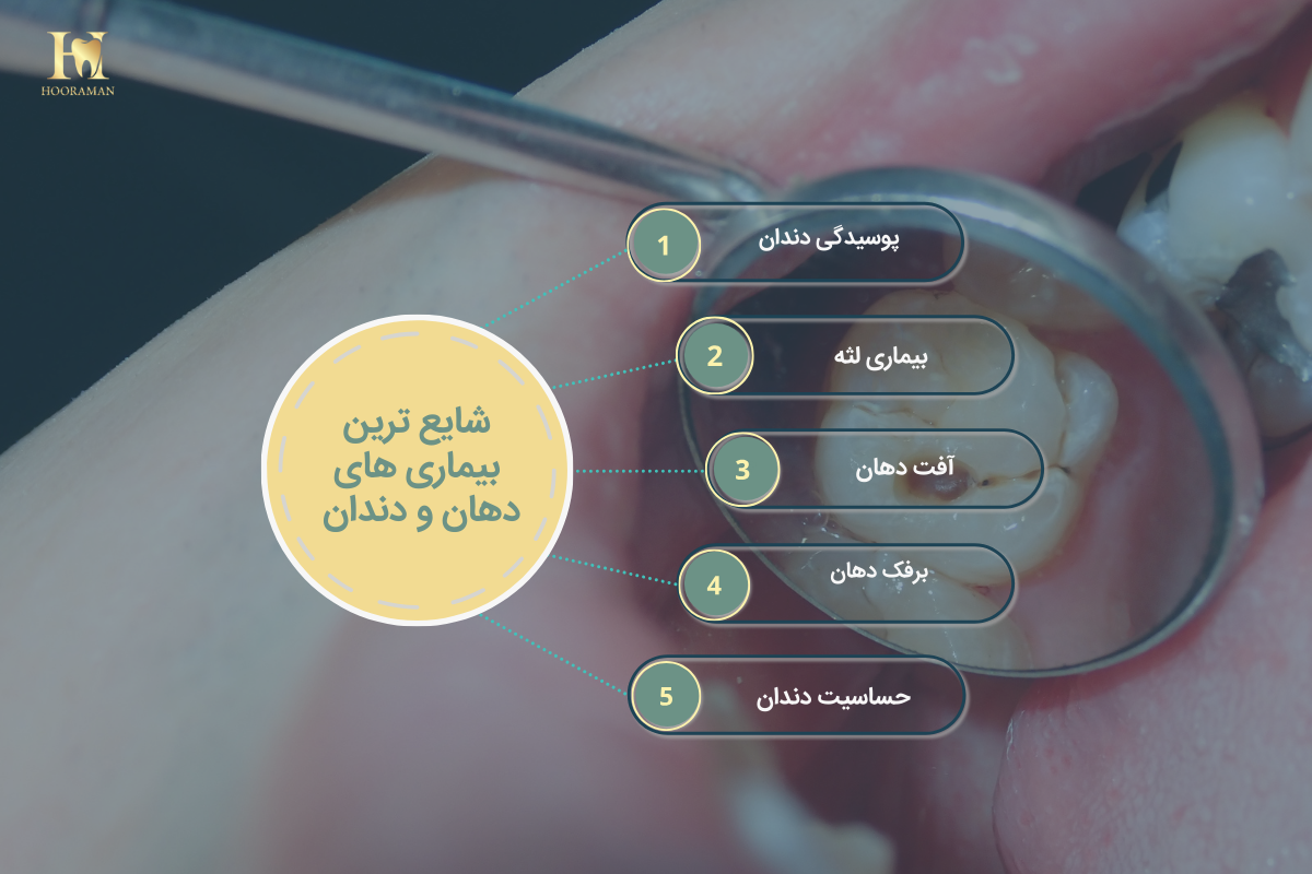 درمان بیماری های دهان و دندان: راهنمای جامع پیشگیری، علائم و درمان موثر آن 1 شایع ترین بیماری های دهان و دندان