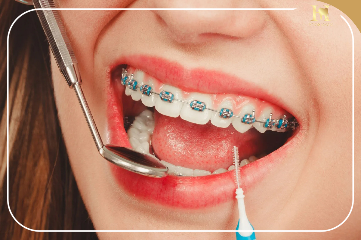 براکت ارتودنسی چیست و چه نقشی در صاف شدن دندانها دارد؟ 1 کاربرد براکت