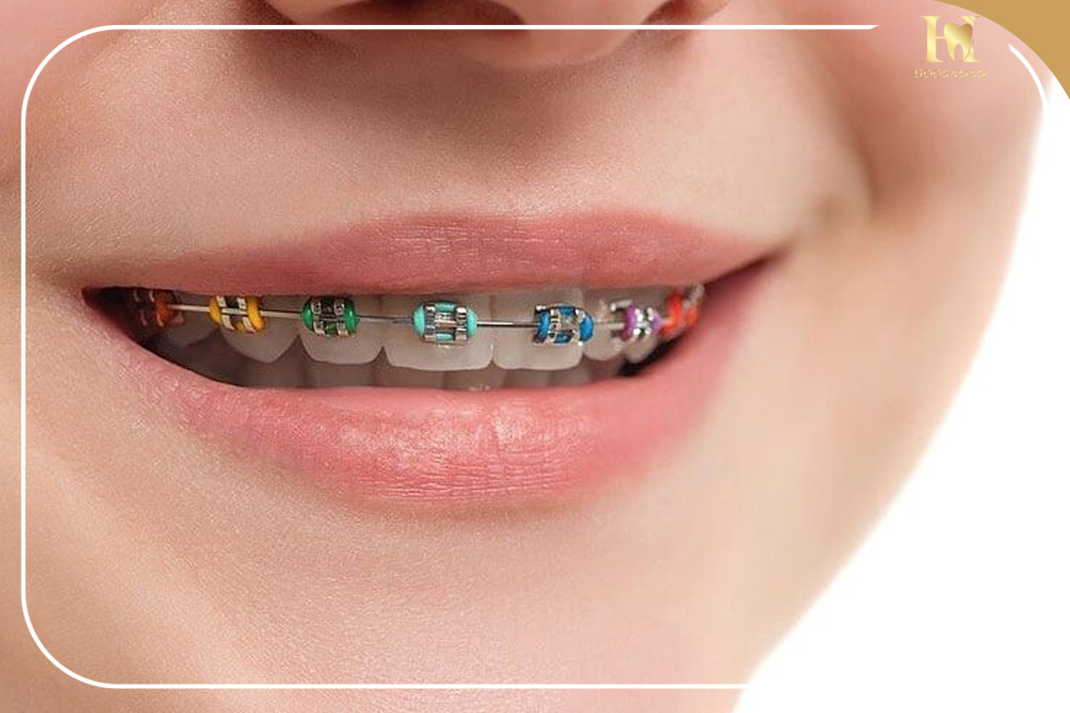 ارتودنسی رنگی در کلینیک دندانپزشکی هورامان: لبخندی زیبا با رنگ دلخواه شما 4 هزینه ارتودنسی رنگی