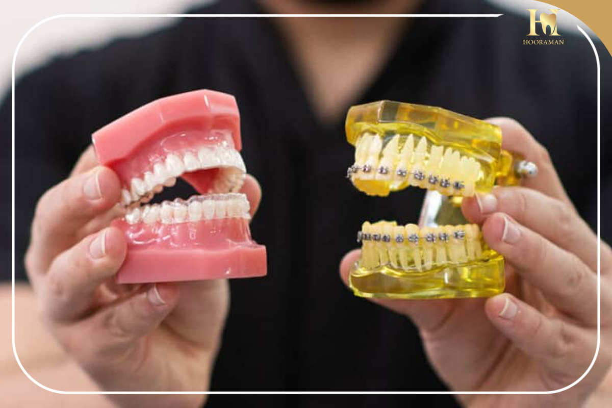 براکت ارتودنسی چیست و چه نقشی در صاف شدن دندانها دارد؟ 4 قیمت براکت ارتودنسی