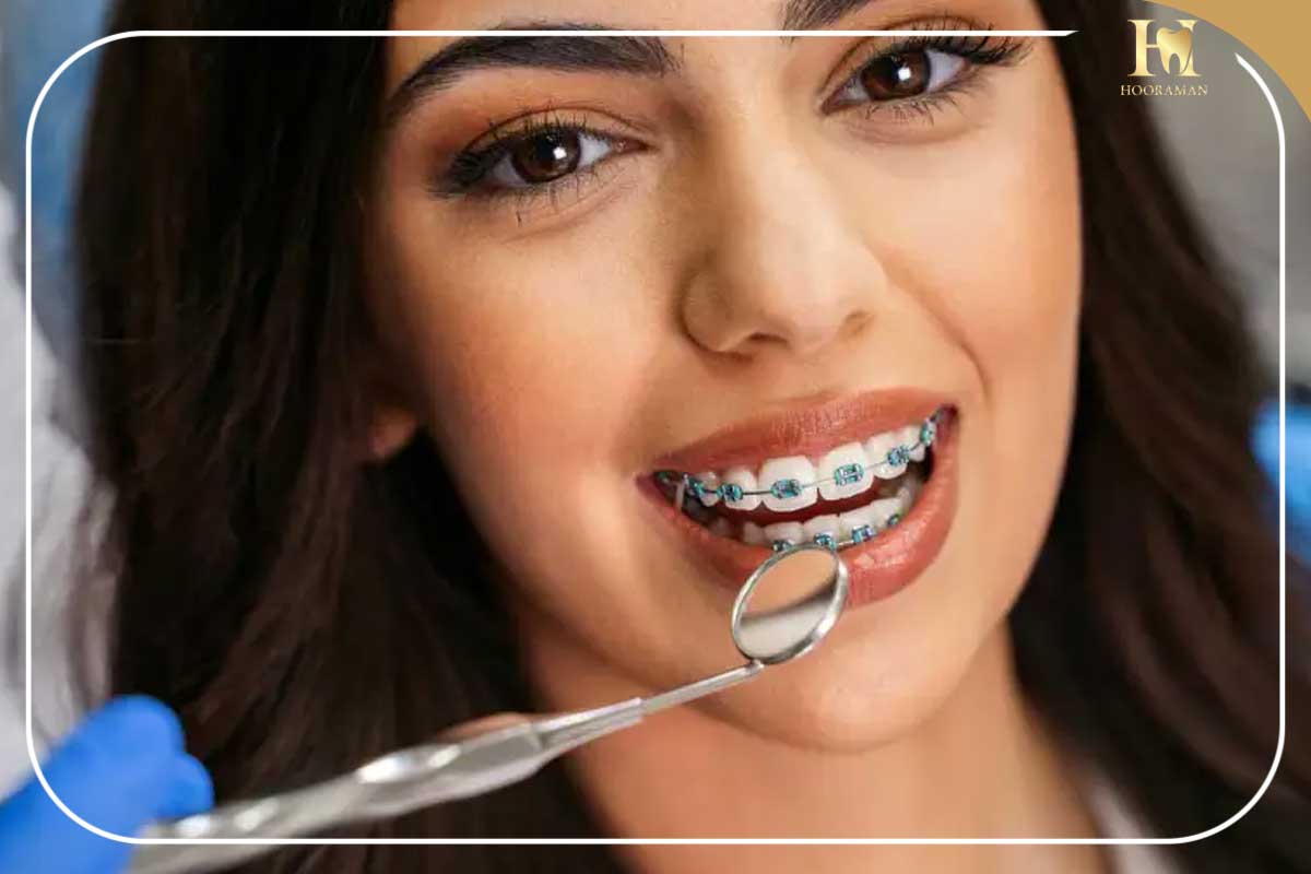 ارتودنسی فک بالا در کلینیک دندانپزشکی هورامان 5 مزایای ارتودنسی فک بالا