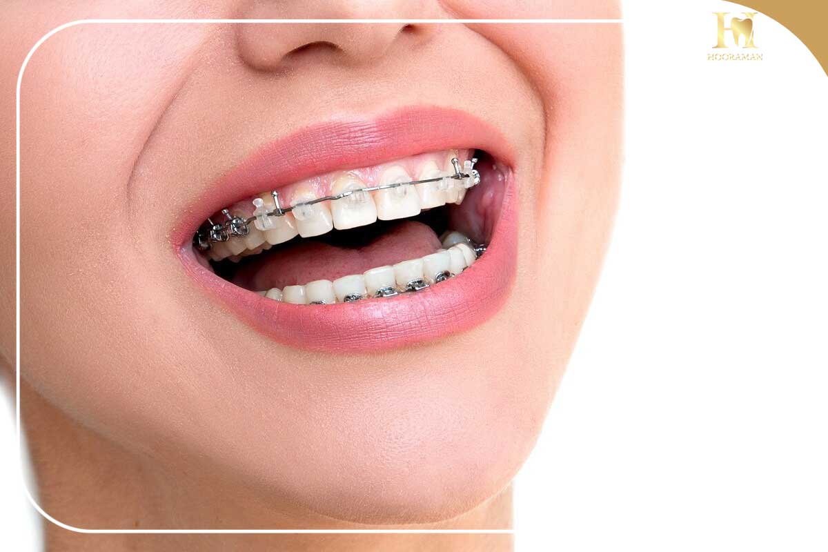 راهنمای طلایی دندانپزشکی با بیمه کارآفرین: مدیریت زمان، شفافیت مالی و درمان بیدغدغه 1 Damon Orthodontics