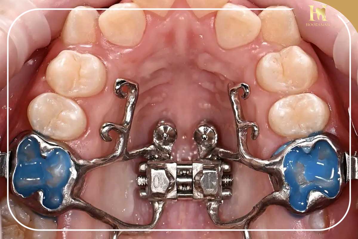 ارتودنسی فانکشنال چیست؟ 9 دستگاه فانکشنال ثابت
