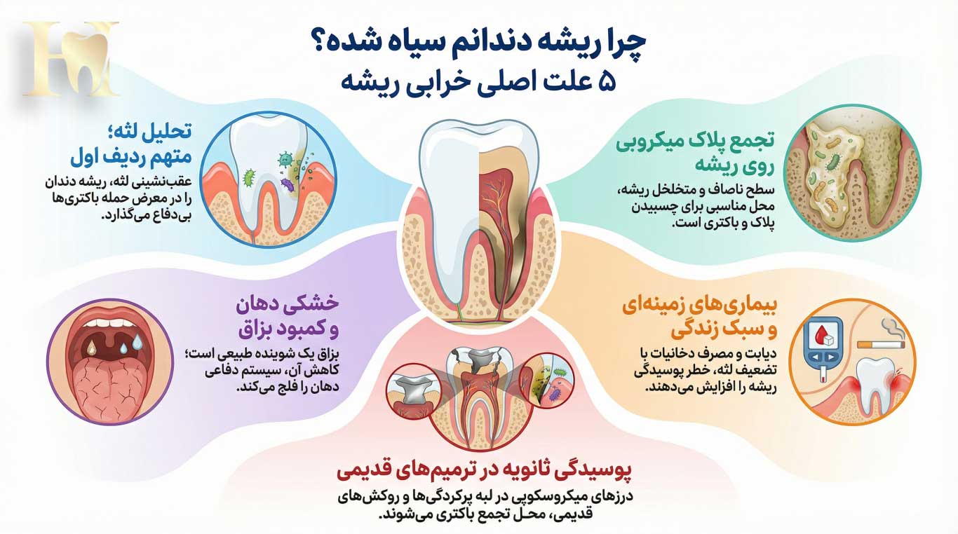 پوسیدگی ریشه دندان؛ علت سیاه شدن، علائم پنهان و جدیدترین روشهای درمان 1 ۵ علت اصلی سیاه شدن و خرابی ریشه دندان