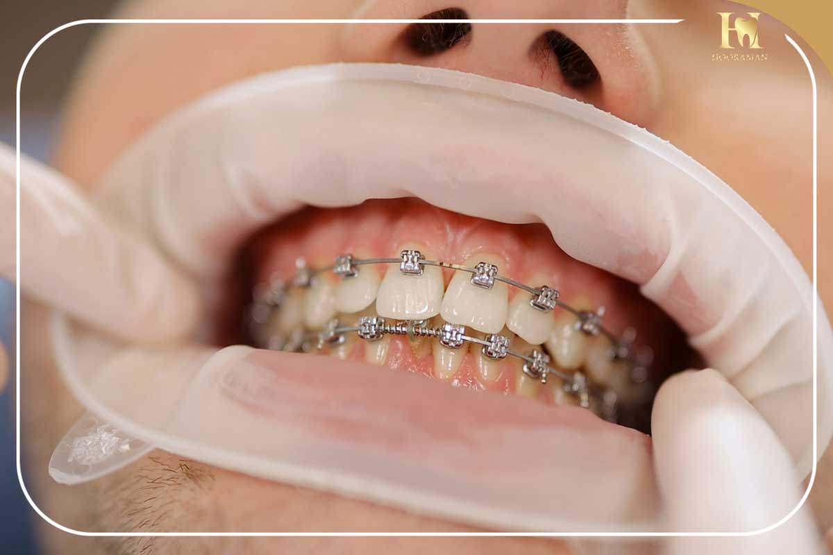 عمل بینی و ارتودنسی: ایا با وجود ارتودنسی میشود عمل بینی انجام داد؟ 3 انجام اورتودنسی