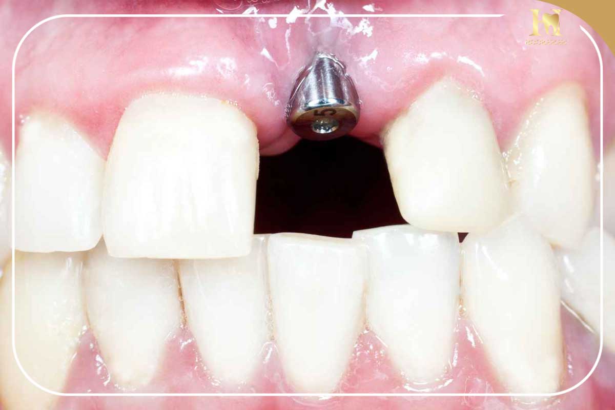 کاهش درد ایمپلنت دندان؛ چه چیزی طبیعی است و برای کاهش درد ایمپلنت چه باید کرد؟ 2 عفونت ایمپلنت دندان